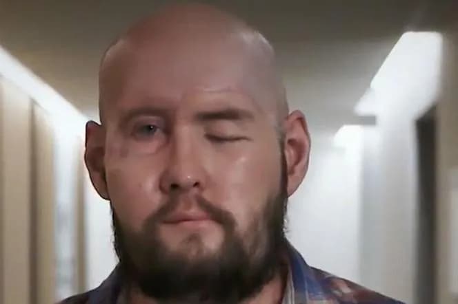 Pierwszy na świecie przeszczep twarzy - historia, która zmienia życie